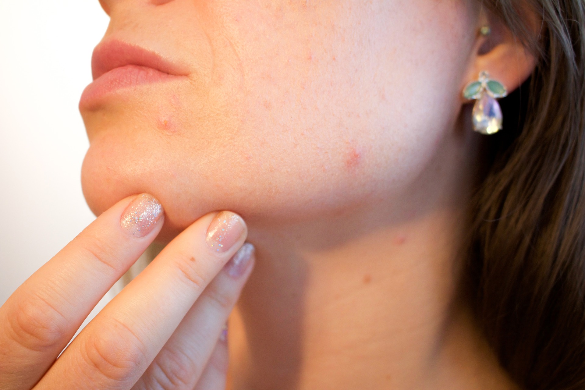 Masken verursachen Akne: einige Tipps zur Vermeidung dieser lästigen Nebenwirkungen