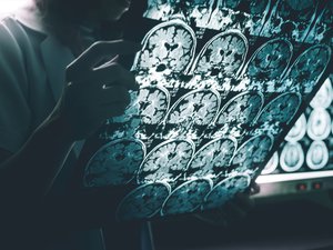 Alzheimer: Gibt es bald ein Impfstoff und eine Behandlung zur Bekämpfung der Krankheit?